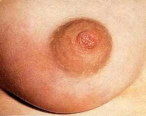 علامات وأعراض سرطان الثدي Mastitis-300x237
