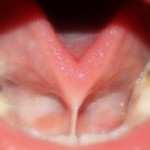 Tongue-Tie Tongue-Tie