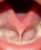 tongue tie before adult