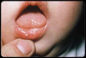 BFB Yeast baby's lips