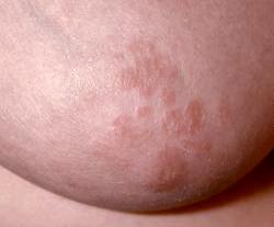 Eczema on my breasts has made my nipples itchy and sore.