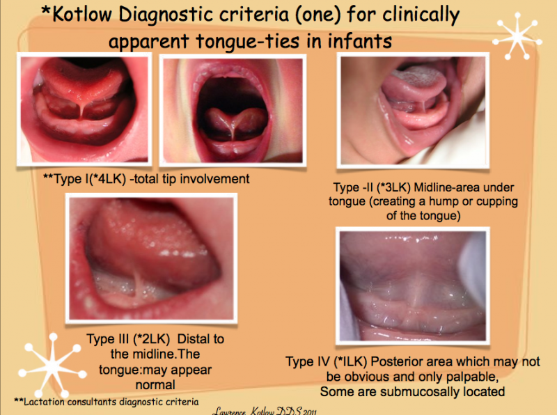 BFB-Tongue-tie-phot-courtesy-of-Dr.-Kotlow.png
